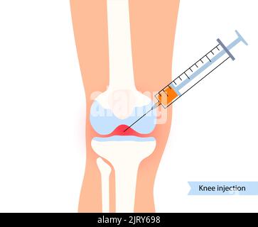 Knieeinspritzung, Abbildung Stockfoto