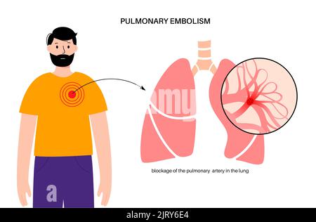 Lungenembolie, Abbildung Stockfoto