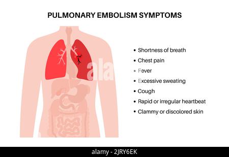 Lungenembolie, Abbildung Stockfoto