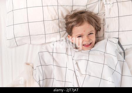 Kind liegt im Bett mit Pockenausschlag Stockfoto