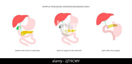 Medizinische Infografik des whipple-Verfahrens Pankreaticoduodenektomie mit Gastrojejunostomie. Operation Operation bei der Behandlung von Bauchspeicheldrüsenkrebs. Stock Vektor