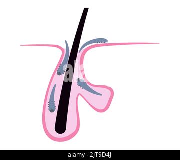 Haarfollikel voller Demodex-Milben, einfache Flat Chart. Medizinische Illustration Stock Vektor