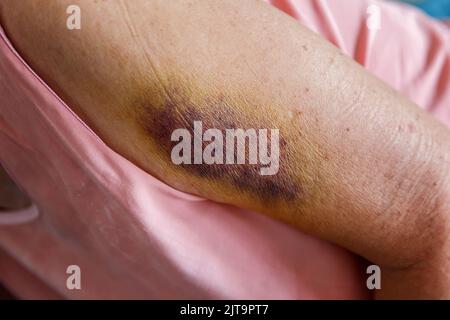 Große dunkle Blutergüsse oder Hämatome am Arm einer älteren Person. Schmerzhafter Unfall. Stockfoto