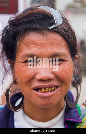 Vietnam, Black Hmong Stammesfrau in Sapa zeigt ihre Zähne, die mit einem Blatt Gold bedeckt sind.Sapa ist eine Stadt in der Nähe der chinesischen Grenze und beliebt bei Stockfoto
