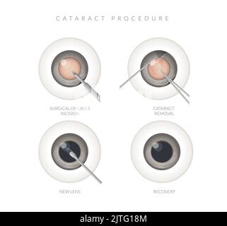 Menschliches Auge - Kataraktverfahren - Abbildung als EPS 10-Datei Stock Vektor