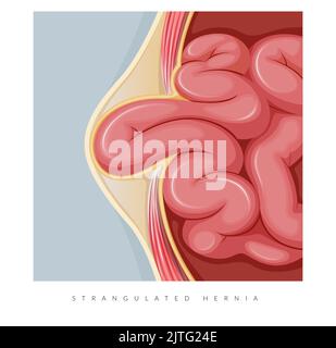 Strangulierter Hernie - Abschnitt des Dünndarms - Stockillustration als EPS 10 Datei Stock Vektor