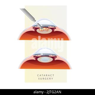 Menschliches Auge - Kataraktverfahren - Abbildung als EPS 10-Datei Stock Vektor