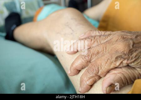 Faltige Hand eines älteren Patienten mit Krampfadern am Oberschenkel Stockfoto