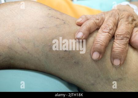 Hand eines älteren Patienten mit Krampfadern am Oberschenkel Stockfoto