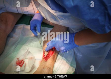 Eine große Lazeration am Unterschenkel ist lokal narbärisiert Stockfoto