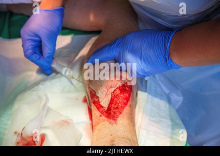 Eine große Lazeration am Unterschenkel ist lokal narbärisiert Stockfoto