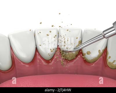 Entfernung von Zahnstein und Plaque von den Zähnen mit Ultraschall Scaler. Zahnmedizinisches Entkalkungskonzept Stockfoto