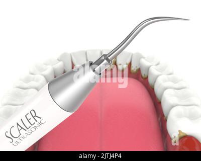 Entfernung von Zahnstein und Plaque von den Zähnen mit Ultraschall Scaler. Zahnmedizinisches Entkalkungskonzept Stockfoto