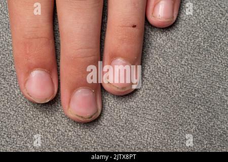 Schmutzige und lange Nägel mit Graten, Kinderfinger und Nägel auf grauem Hintergrund, Nägel und Schmutz im Detail und Nahaufnahme. Stockfoto