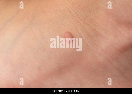 Gemeine Warze Verruca vulgaris auf der Haut eines Kindes, Papillomavirus im Körper. Stockfoto