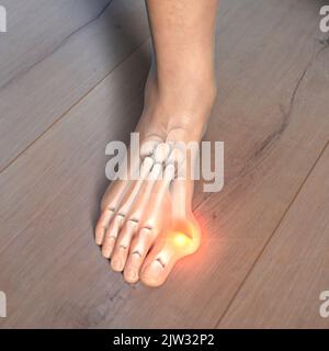 Hallux valgus, Illustration. Ein Hallux valgus, oder Bunion, ist eine abnorme Abweichung der Großzehe, die zu einer Deformation an der Vorderseite des Fußes am ersten Mittelfußbereich der Großzehe führt. Stockfoto