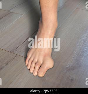 Hallux valgus, Illustration. Ein Hallux valgus, oder Bunion, ist eine abnorme Abweichung der Großzehe, die zu einer Deformation an der Vorderseite des Fußes am ersten Mittelfußbereich der Großzehe führt. Stockfoto