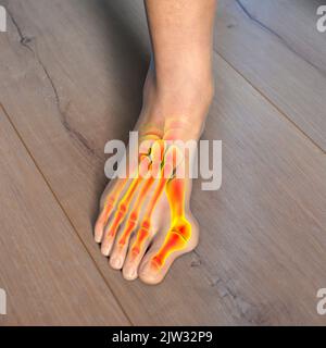 Hallux valgus, Illustration. Ein Hallux valgus, oder Bunion, ist eine abnorme Abweichung der Großzehe, die zu einer Deformation an der Vorderseite des Fußes am ersten Mittelfußbereich der Großzehe führt. Stockfoto