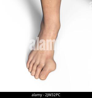 Hallux valgus, Illustration. Ein Hallux valgus, oder Bunion, ist eine abnorme Abweichung der Großzehe, die zu einer Deformation an der Vorderseite des Fußes am ersten Mittelfußbereich der Großzehe führt. Stockfoto