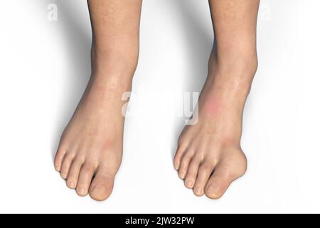 Hallux valgus, Illustration. Ein Hallux valgus, oder Bunion, ist eine abnorme Abweichung der Großzehe, die zu einer Deformation an der Vorderseite des Fußes am ersten Mittelfußbereich der Großzehe führt. Stockfoto