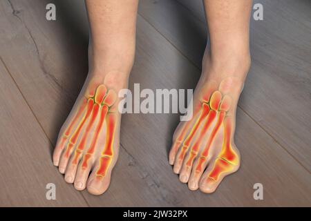 Hallux valgus, Illustration. Ein Hallux valgus, oder Bunion, ist eine abnorme Abweichung der Großzehe, die zu einer Deformation an der Vorderseite des Fußes am ersten Mittelfußbereich der Großzehe führt. Stockfoto