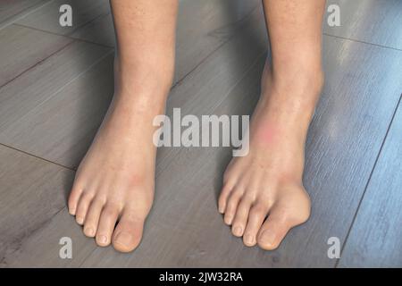 Hallux valgus, Illustration. Ein Hallux valgus, oder Bunion, ist eine abnorme Abweichung der Großzehe, die zu einer Deformation an der Vorderseite des Fußes am ersten Mittelfußbereich der Großzehe führt. Stockfoto