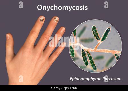 Illustration einer Nagelpilz-Infektion mit einer menschlichen Hand mit Onychomykose und einer Nahaufnahme von Epidermophyton floccosum-Pilzen, einem der ursächlichen Erreger von Nagelinfektionen. Stockfoto