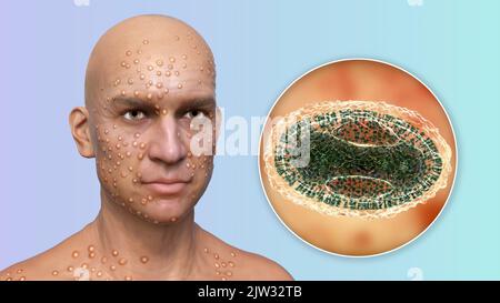 Patient mit Pocken (Variola) und Nahaufnahme eines Pockenvirus, Illustration. Pocken sind eine Krankheit, die Fieber und oft den Tod verursacht. Es wurde nach weltweiten Anstrengungen im Jahr 1970s ausgerottet, aber es gibt Stämme in Forschungslabors. Ähnliche Hautläsionen finden sich in derzeit verfügbaren Viren aus der Poxviridae-Familie, wie z. B. Monkeypox, die ebenfalls die gleiche Virion-Morphologie haben. Stockfoto