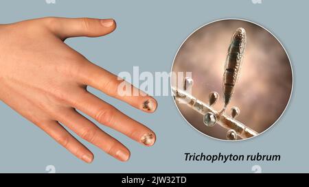 Illustration einer Nagelpilz-Infektion mit einer menschlichen Hand mit Onychomykose und einer Nahaufnahme von Trichophyton rubrum Pilzen, einem der ursächlichen Erreger von Nagelinfektionen. Stockfoto