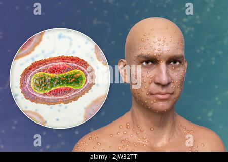 Patient mit Pocken (Variola) und Nahaufnahme eines Pockenvirus, Illustration. Pocken sind eine Krankheit, die Fieber und oft den Tod verursacht. Es wurde nach weltweiten Anstrengungen im Jahr 1970s ausgerottet, aber es gibt Stämme in Forschungslabors. Ähnliche Hautläsionen finden sich in derzeit verfügbaren Viren aus der Poxviridae-Familie, wie z. B. Monkeypox, die ebenfalls die gleiche Virion-Morphologie haben. Stockfoto