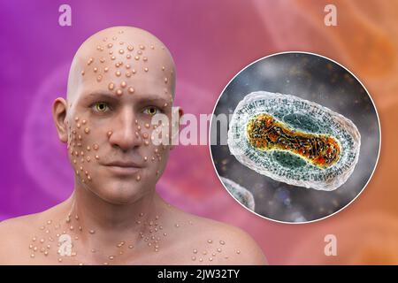 Patient mit Pocken (Variola) und Nahaufnahme eines Pockenvirus, Illustration. Pocken sind eine Krankheit, die Fieber und oft den Tod verursacht. Es wurde nach weltweiten Anstrengungen im Jahr 1970s ausgerottet, aber es gibt Stämme in Forschungslabors. Ähnliche Hautläsionen finden sich in derzeit verfügbaren Viren aus der Poxviridae-Familie, wie z. B. Monkeypox, die ebenfalls die gleiche Virion-Morphologie haben. Stockfoto