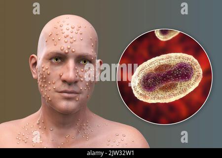 Patient mit Pocken (Variola) und Nahaufnahme eines Pockenvirus, Illustration. Pocken sind eine Krankheit, die Fieber und oft den Tod verursacht. Es wurde nach weltweiten Anstrengungen im Jahr 1970s ausgerottet, aber es gibt Stämme in Forschungslabors. Ähnliche Hautläsionen finden sich in derzeit verfügbaren Viren aus der Poxviridae-Familie, wie z. B. Monkeypox, die ebenfalls die gleiche Virion-Morphologie haben. Stockfoto