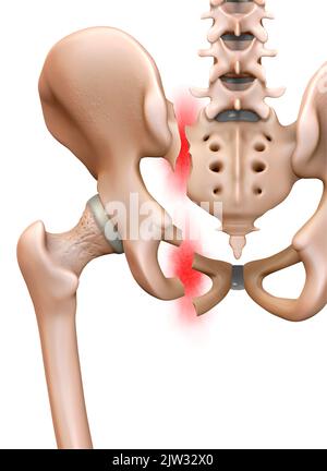 Abbildung zeigt die Rückansicht eines gebrochenen Beckens. Stockfoto