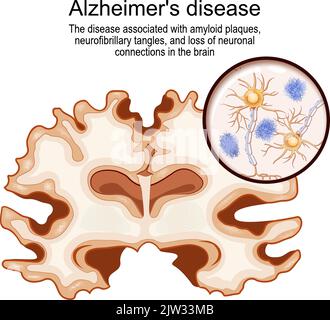 Alzheimer-Krankheit. Krankheit im Zusammenhang mit Amyloid-Plaques, neurofibrillaren Verwicklungen und Verlust neuronaler Verbindungen im Gehirn. Menschliches Gehirn Stock Vektor