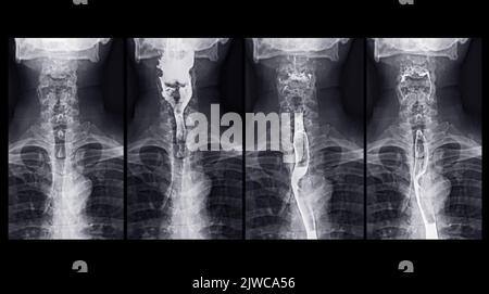Barium Swallow study Test diagnostiziere Barrett's GI tract exam GERD ulcers series difficulty pharynx procedure UGI throat darm therapy by Fluoroscopy dev Stockfoto