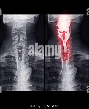 Barium Swallow study Test diagnostiziere Barrett's GI tract exam GERD ulcers series difficulty pharynx procedure UGI throat darm therapy by Fluoroscopy dev Stockfoto