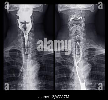 Barium Swallow study Test diagnostiziere Barrett's GI tract exam GERD ulcers series difficulty pharynx procedure UGI throat darm therapy by Fluoroscopy dev Stockfoto