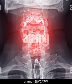 Barium Swallow study Test diagnostiziere Barrett's GI tract exam GERD ulcers series difficulty pharynx procedure UGI throat darm therapy by Fluoroscopy dev Stockfoto