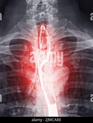 Barium Swallow study Test diagnostiziere Barrett's GI tract exam GERD ulcers series difficulty pharynx procedure UGI throat darm therapy by Fluoroscopy dev Stockfoto