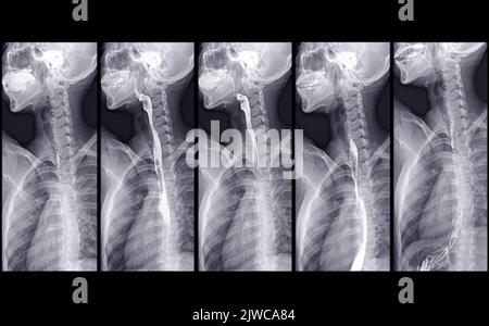Barium Swallow study Test diagnostiziere Barrett's GI tract exam GERD ulcers series difficulty pharynx procedure UGI throat darm therapy by Fluoroscopy dev Stockfoto