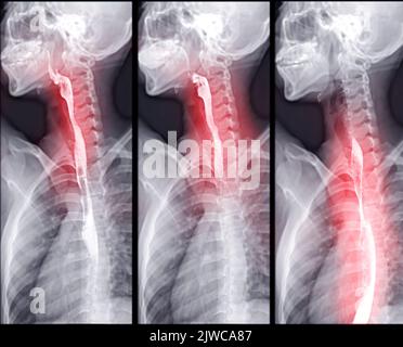 Barium Swallow study Test diagnostiziere Barrett's GI tract exam GERD ulcers series difficulty pharynx procedure UGI throat darm therapy by Fluoroscopy dev Stockfoto