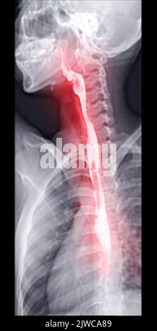 Barium Swallow study Test diagnostiziere Barrett's GI tract exam GERD ulcers series difficulty pharynx procedure UGI throat darm therapy by Fluoroscopy dev Stockfoto