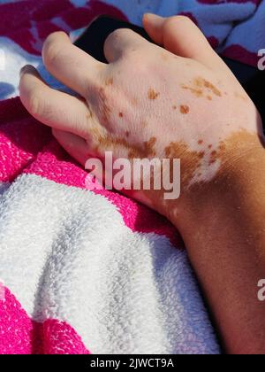 Frauenhand mit Vitiligo Stockfoto