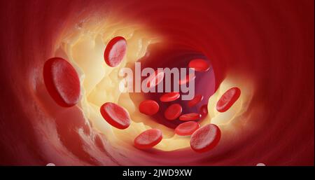 Rote Blutkörperchen treten durch die Cholesterinplaque in die Arterien oder Venen aus. 3D Abbildung. Stockfoto