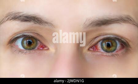 Nahaufnahme einer jungen Frau mit roten Augen. Konjunktivitis, Wunde Augen Stockfoto