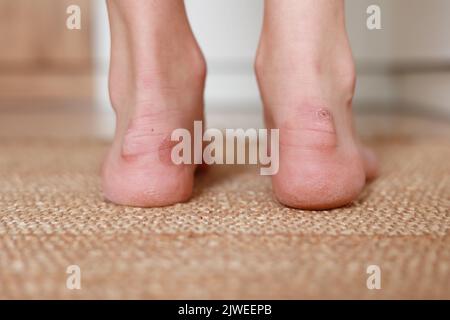 Callus Blasen auf Frauen Füße. Schmerzhafte Wunden. Unbequeme Schuhe Probleme. Blick auf den Fuß mit entzündlichen Hühneraugen. Gesundheits- und Schönheitskonzept Stockfoto