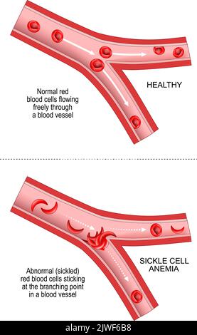 Sichelzellkrankheit. SCD ist eine Erkrankung, die von den Eltern einer Person vererbt wird. Anämie oder Anämie. Vergleich und Unterschied zwischen Blutgefäßen Stock Vektor