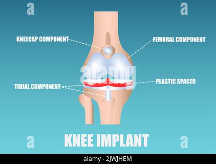 Vektor eines menschlichen Knieimplantats Stock Vektor