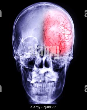 Zerebrale Angiographie aus der Durchleuchtung mit Schädel des Menschen, der die Hirnarterie zeigt. Stockfoto