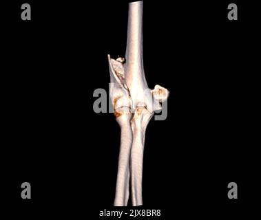 Computertomographie Volumendarstellung Untersuchung des Ellenbogengelenks 3D Rendering in Patientenfraktur Ellenbogengelenk. Stockfoto